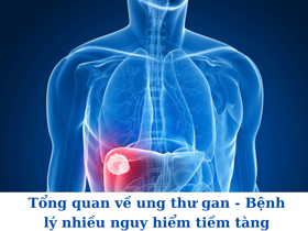 Tổng quan về ung thư gan - Bệnh lý nhiều nguy hiểm tiềm tàng